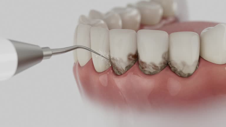 Reliable Dental Implants contractor in Bel-Ridge, MO by Smile Center Dentistry